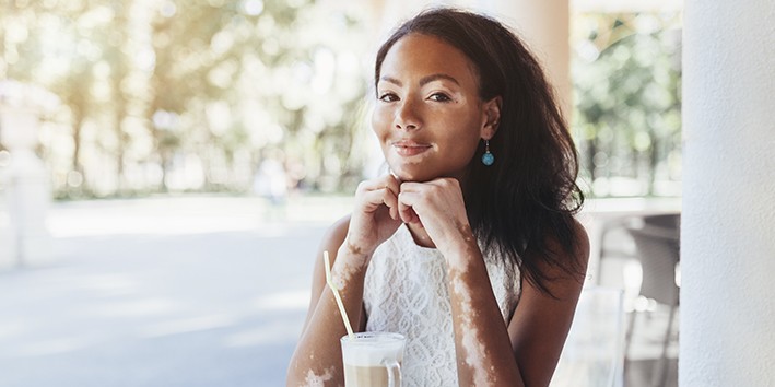 Mulher negra com vitiligo